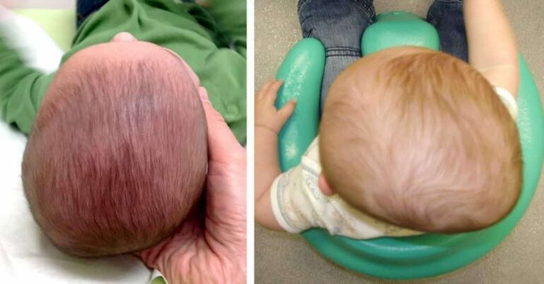 Plagiocefalia: ¿Cómo prevenir y tratar la cada vez más frecuente deformidad de cabeza de los bebés?