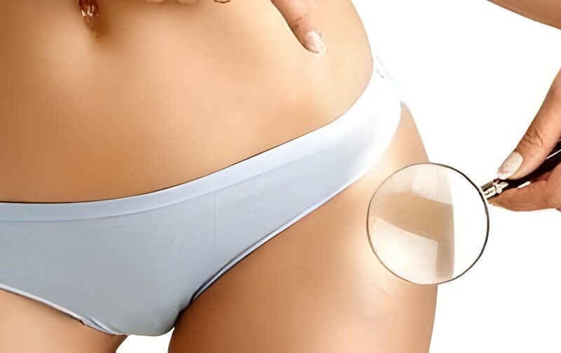 8 Pasos para acabar con la celulitis