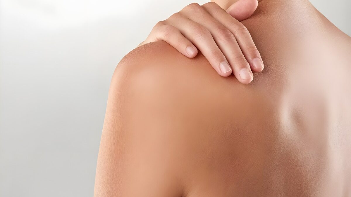 Hidrosadenitis Supurativa: una desconocida y común enfermedad autoinmune