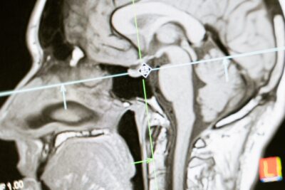 MRI brain scan with targeting crosshairs showing the sagittal brain anatomy used in neuroimaging research