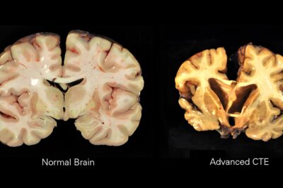 Coronal slices of a normal brain and a brain with advanced CTE, which shows shrunken tissue and enlarged ventricles
