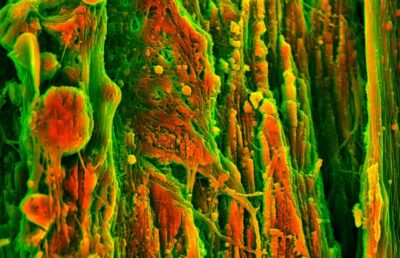 Microscope close-up of a calcified carotid artery plaque, orange mineral deposits woven through green collagen fibres