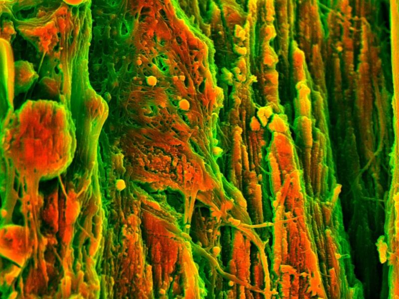 Placca nelle arterie prima dei 30 anni, ce l’ha già 1 adulto su 13 senza sintomi